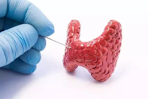 甲状腺疾。鬃聪俟δ芗跬撕图鬃聪俟δ芸航，自古以来就是反复被医学研究人员研究的疾病