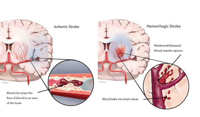 世界卒中日：从动物药效模型评价看心脑血管药物开发